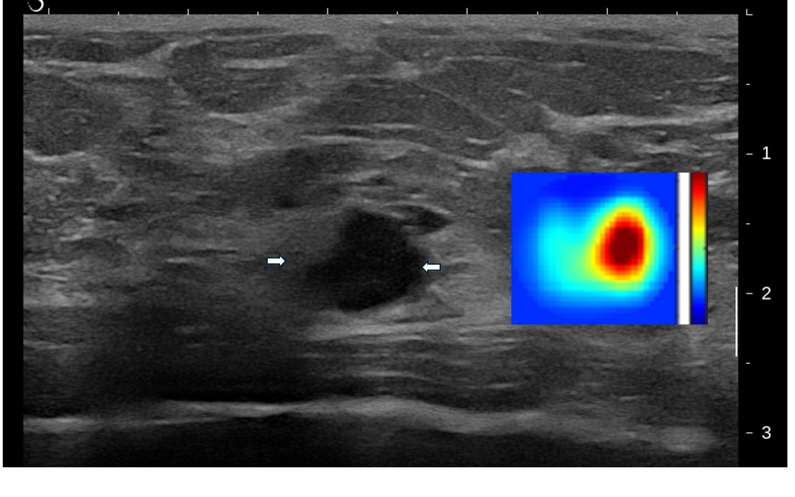The image above is from a 63-year-old woman with targeted-ultrasound demonstrated an irregular mass detected by a screening mammogram. The total hemoglobin concentration (HbT) map (inset) showed high HbT levels, which raises suspicion for cancer.  The calculated blood oxygen saturation level was at the lower end. The HbT and blood oxygen saturation levels were presented to the radiologists in the study, which increased the confidence of a malignant diagnosis. The biopsy results revealed grade 3 triple-negative breast cancer, measuring 2 centimeters.  (Credit: Zhu lab)